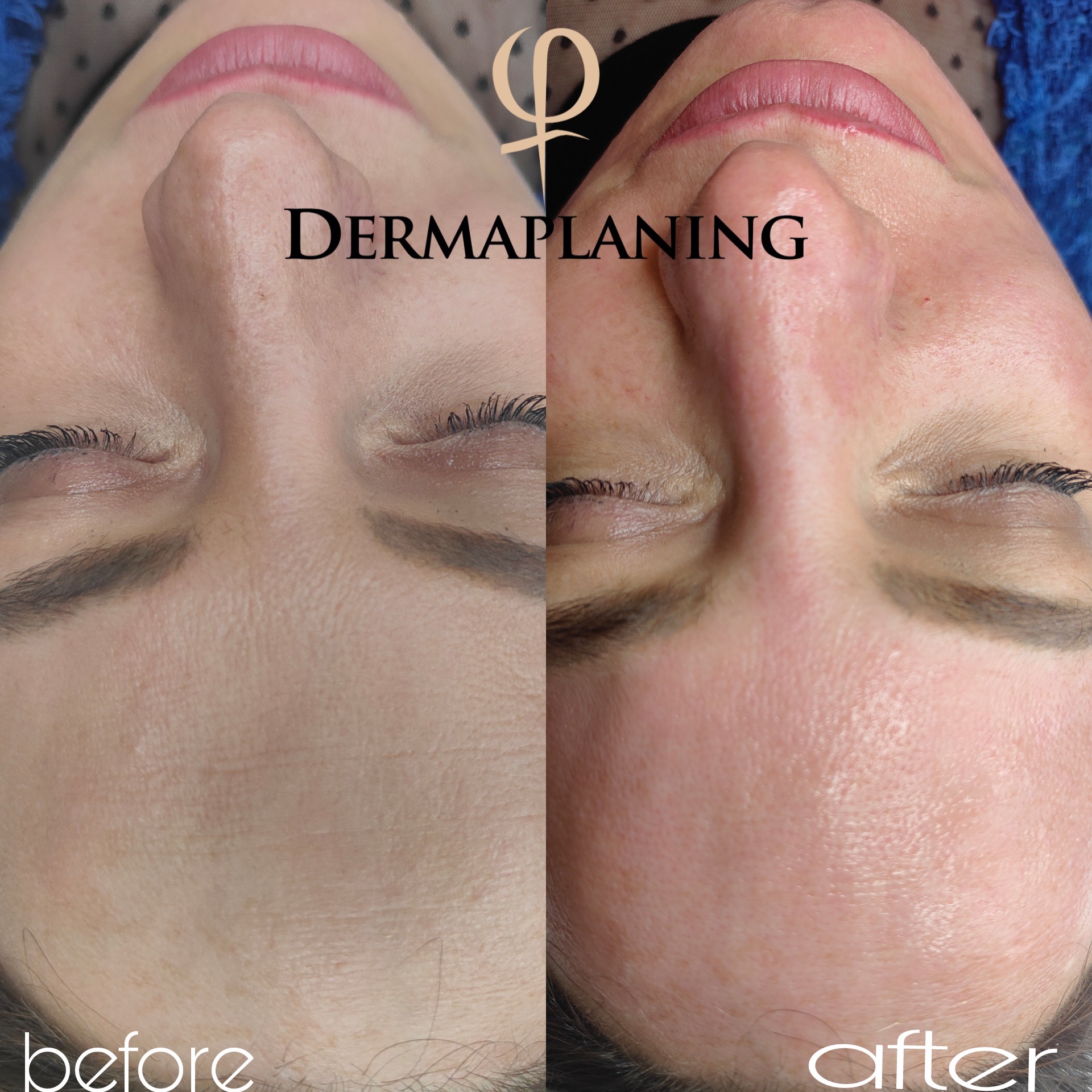Dermaplaning — prima e dopo